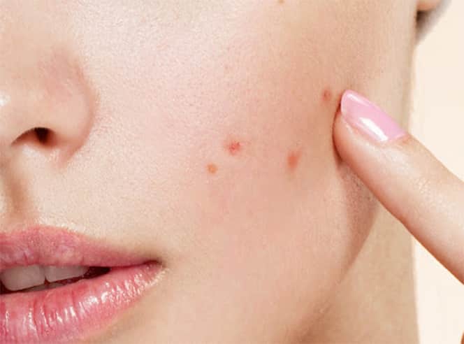 blog acne pic1